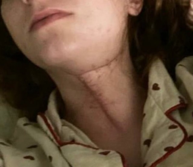 Жительница Подмосковья попала в реанимацию с абсцессом после удаления зуба мудрости в частной клинике