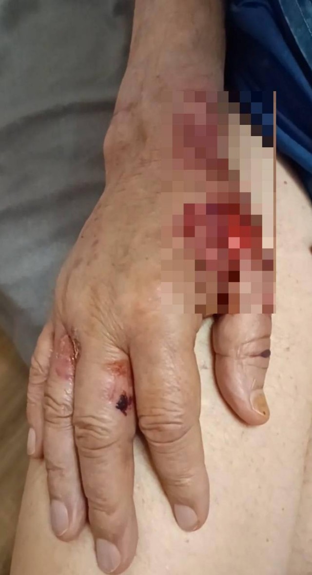 78-летнего дедушку с альцгеймером жестоко травмировали в частном подмосковном доме престарелых