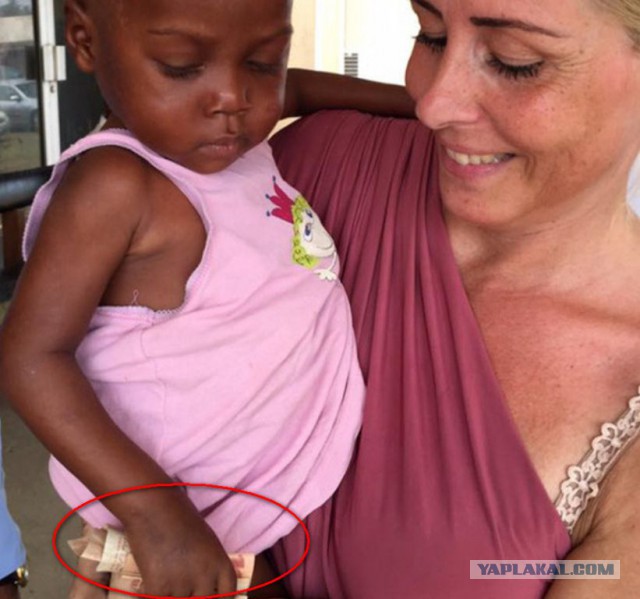 Как стал выглядеть спасенный мальчик, едва не умерший от недоедания