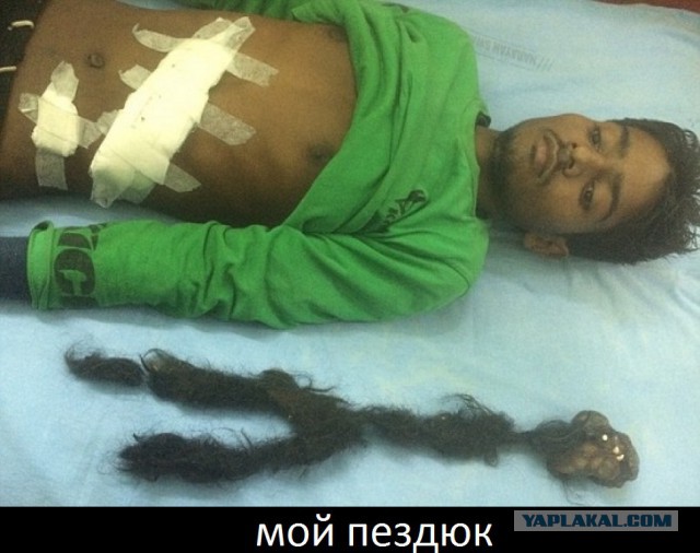 Мохнатый близнец-паразит внутри молодого человека