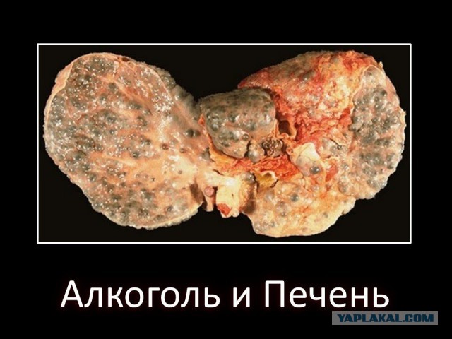 Печень алкоголика, спившегося крафтовым пивом