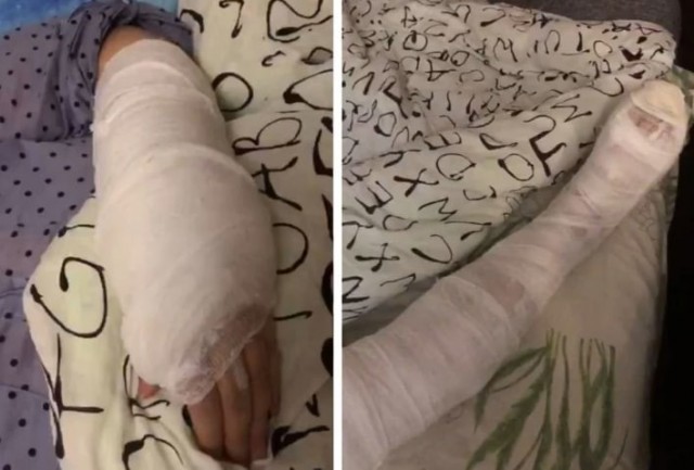 Жительница Екатеринбурга сломала руку в травмпункте. Туда она пришла со сломанной ногой