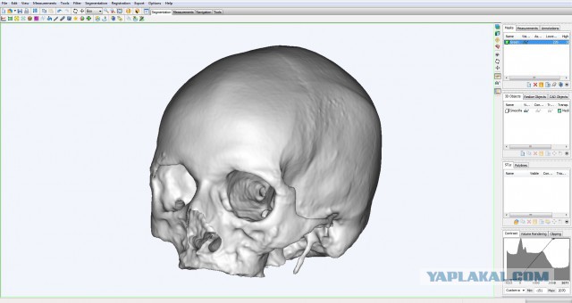 3D на службе у хирурга. О моей работе