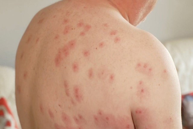 «Я чувствовал их в своих брюках. Они были везде»: мужчина выжил после того, как его 240 раз укусили осы