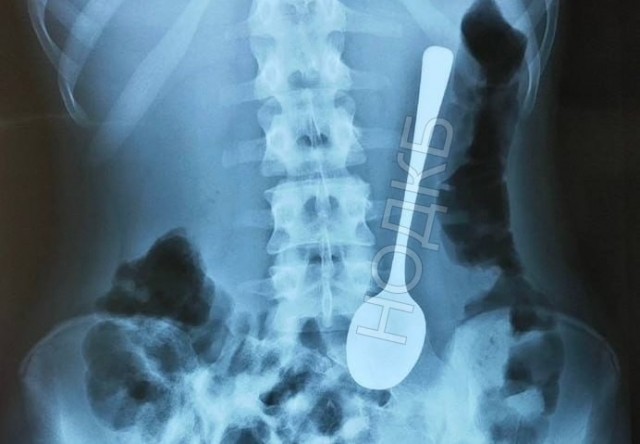 Игрушки были, монеты были, но ложка... Именно ее проглотил юный нижегородец.