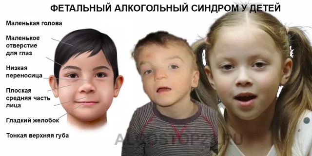 Пьяный младенец родился у матери-алкоголички в Польше