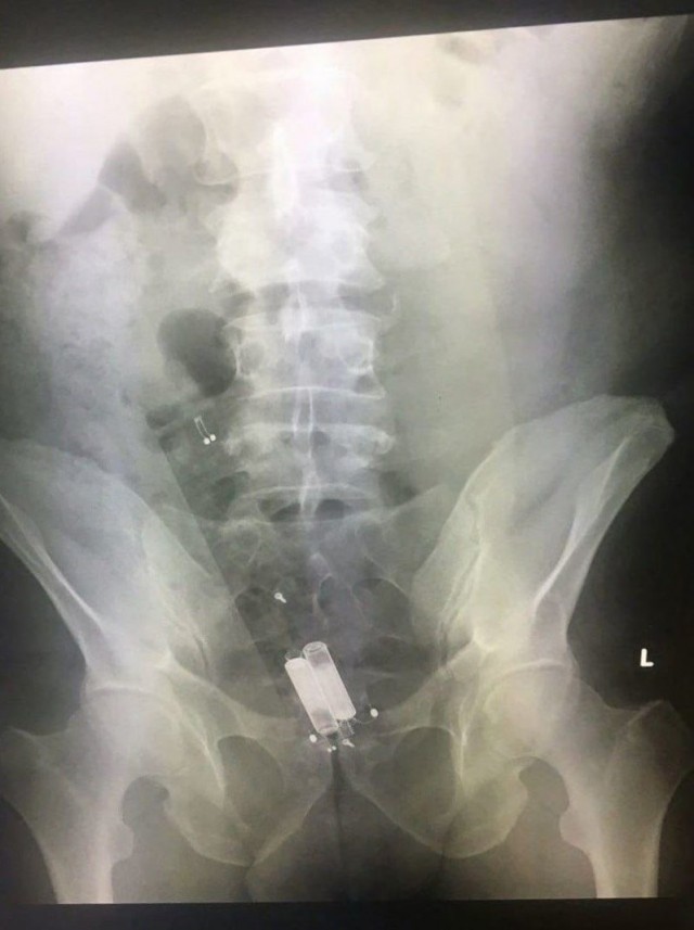 Любитель телепередач из Москвы случайно сел на пульт от телевизора.