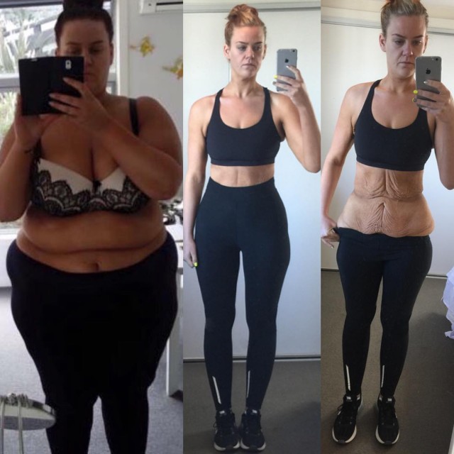 Новозеландка выложила процесс похудения почти на целых 100 килограммов