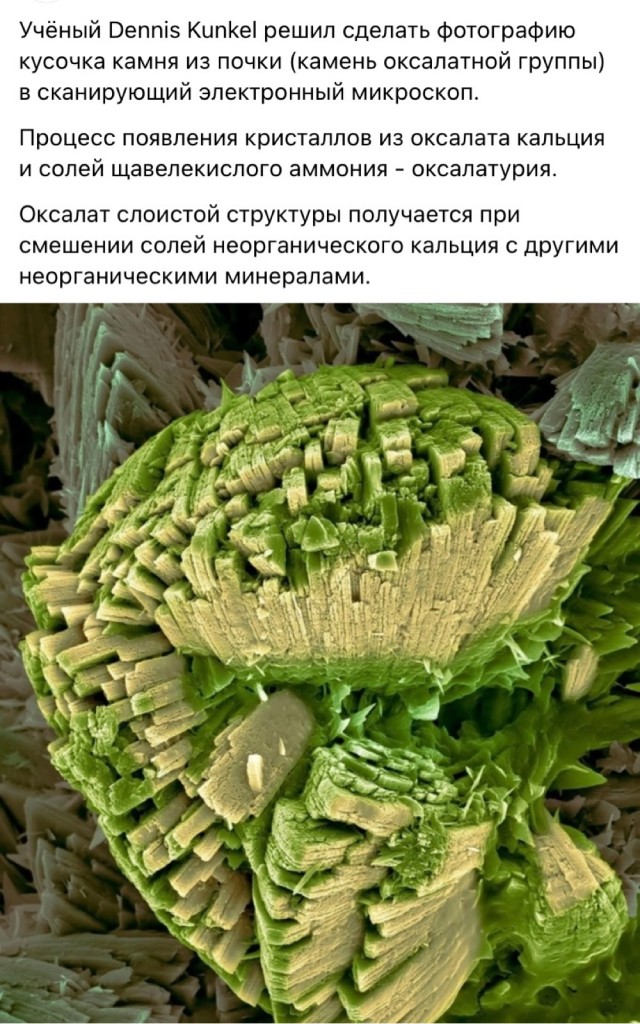 Интересной формы камень в мочевом пузыре