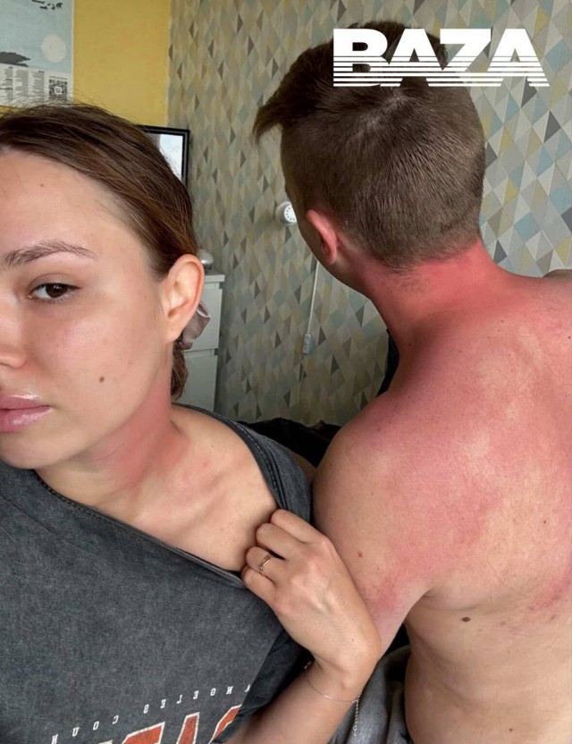 Москвичи решили вылечить боль в шее тайской мазью с ядом скорпиона. Затем им потребовалось «противоядие».