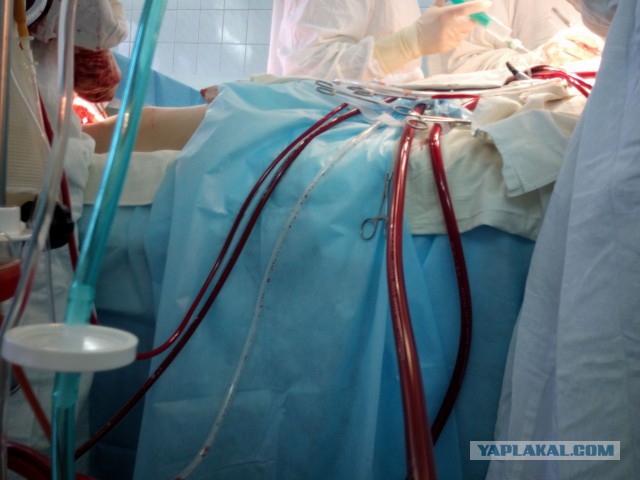 Искусственное кровообращение