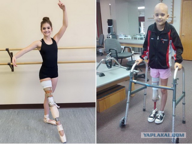 Вдохновляющий пример: девушка с протезом ноги стала прекрасной танцовщицей