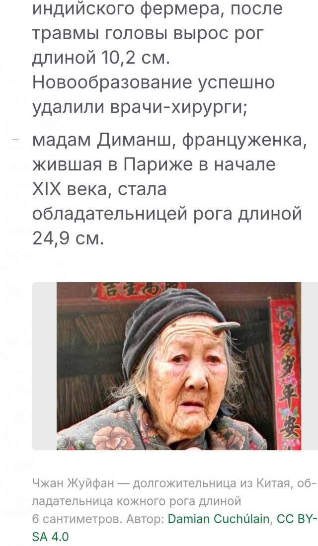 Гигантский «дьявольский рог» удалили мужчине из Набережных Челнов