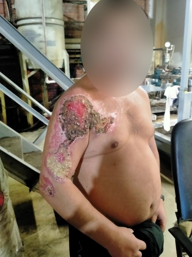 Девушка показала ноги, которые 27 лет назад полностью обварил кипяток из самовара