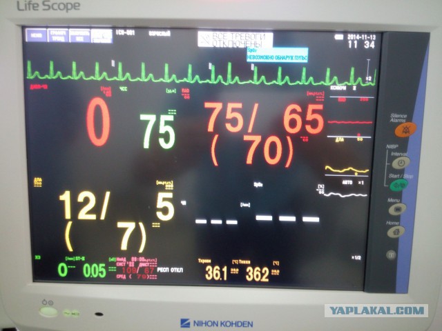 Искусственное кровообращение