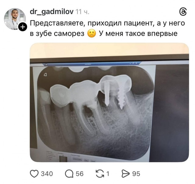 К стоматологу пришёл пациент с зубом, прикрученным на саморез