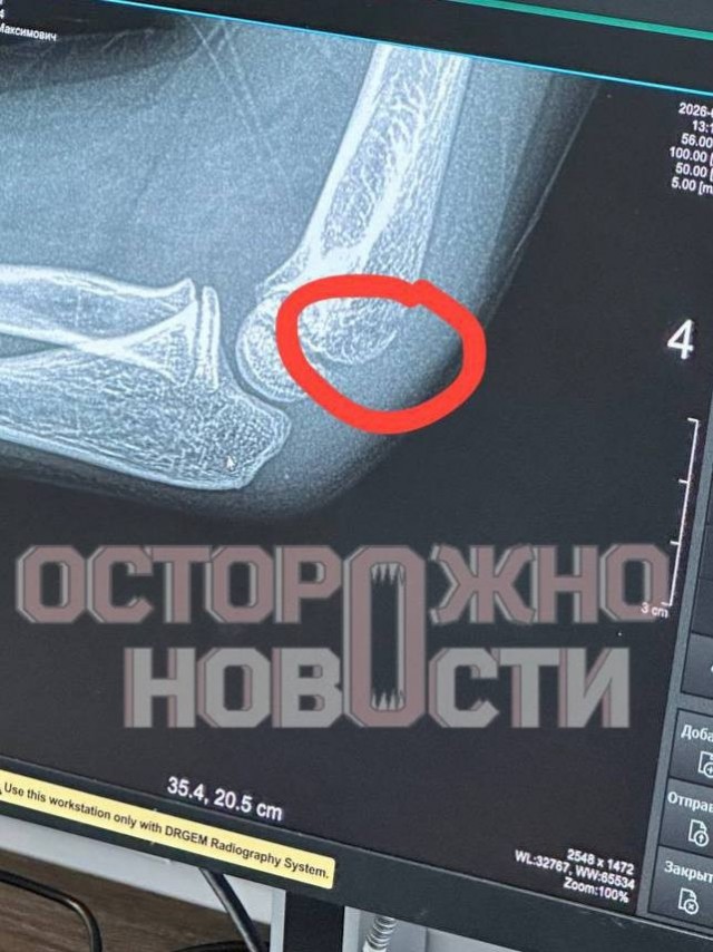 Учитель частного лицея в Подмосковье сломал руку третьекласснику.