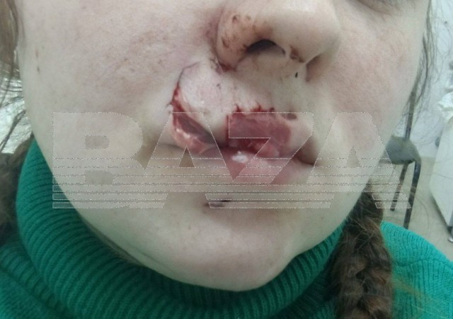 Молодая мама осталась без верхней губы после нападения бродячего пса в Саратове