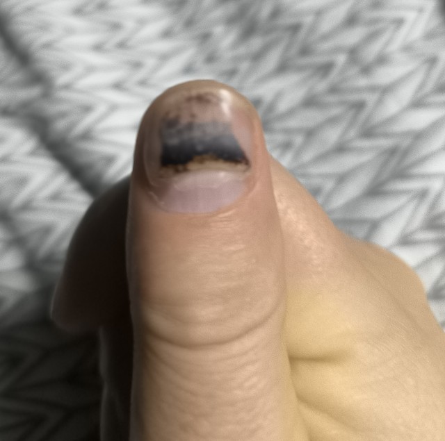 Из жизни одного пальчика
