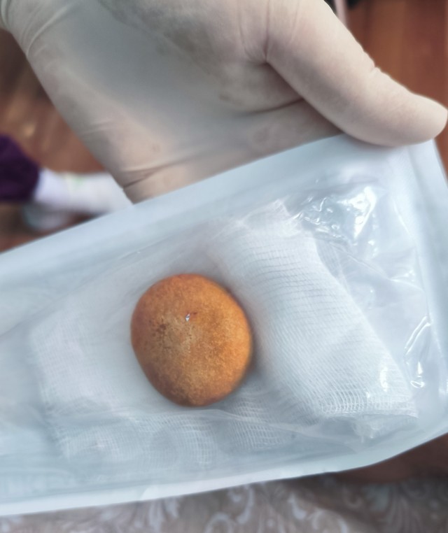 Камни в почках⁠⁠