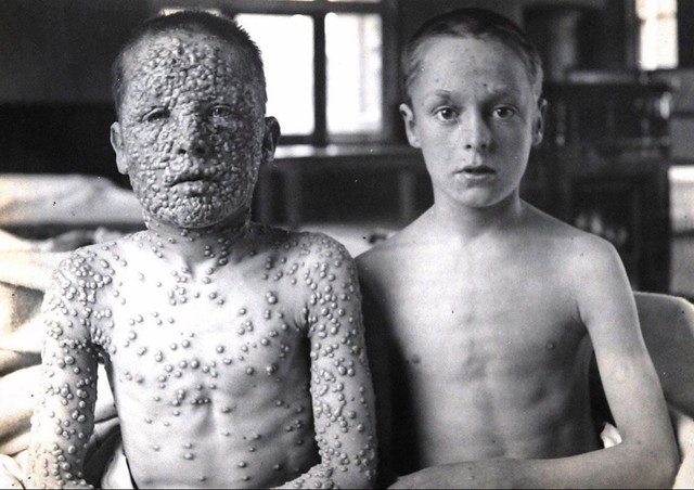 На этой фотографии два мальчика, подвергшихся воздействию одного и того же источника оспы