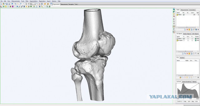 3D на службе у хирурга. О моей работе