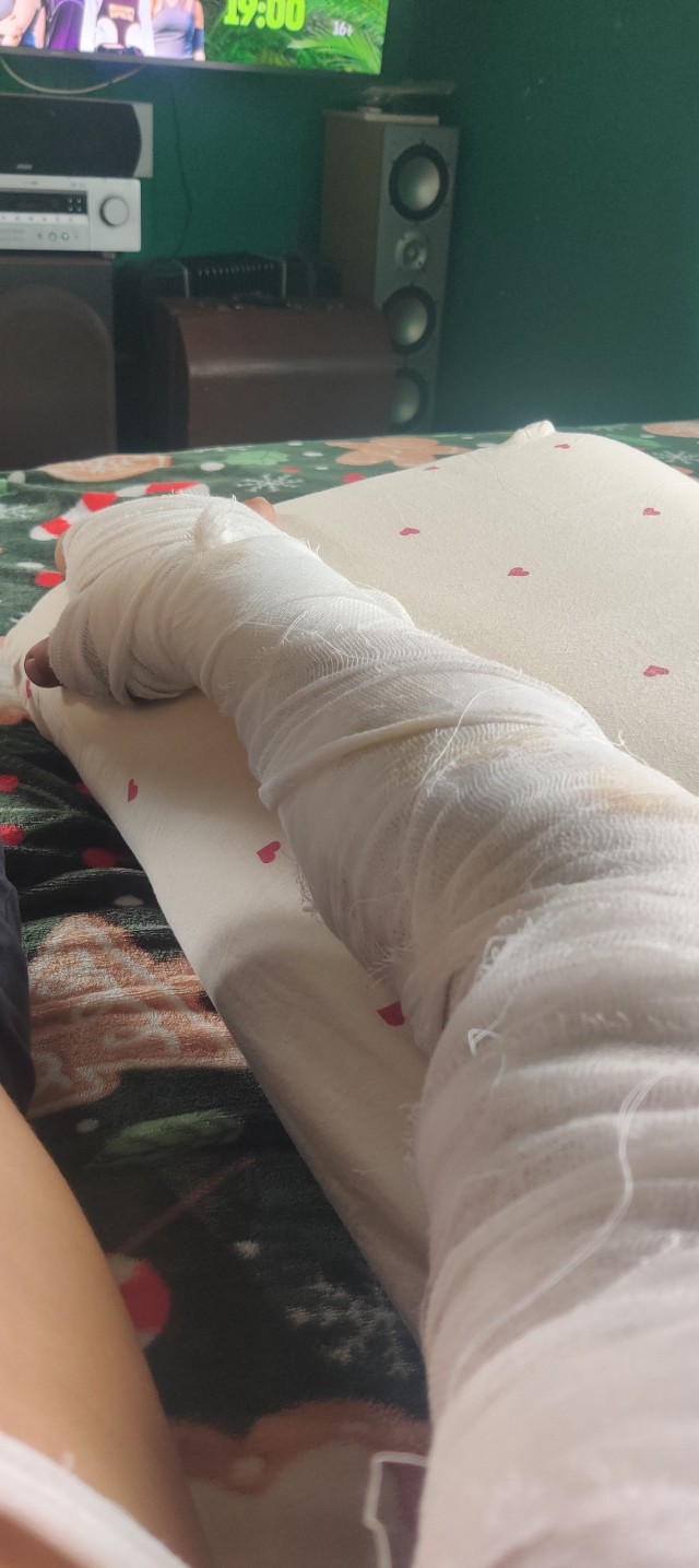 Девушка показала ноги, которые 27 лет назад полностью обварил кипяток из самовара