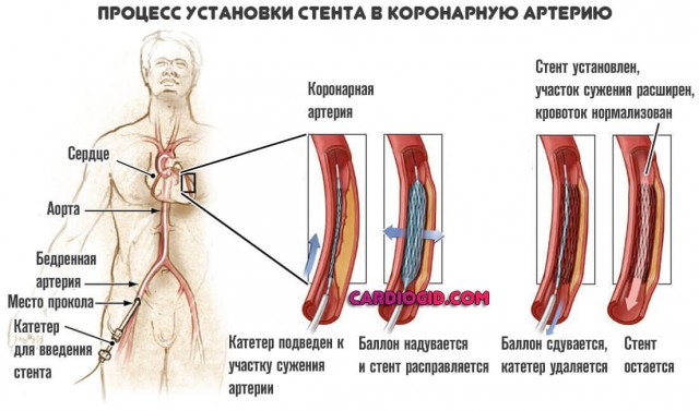 15 минут до инфаркта