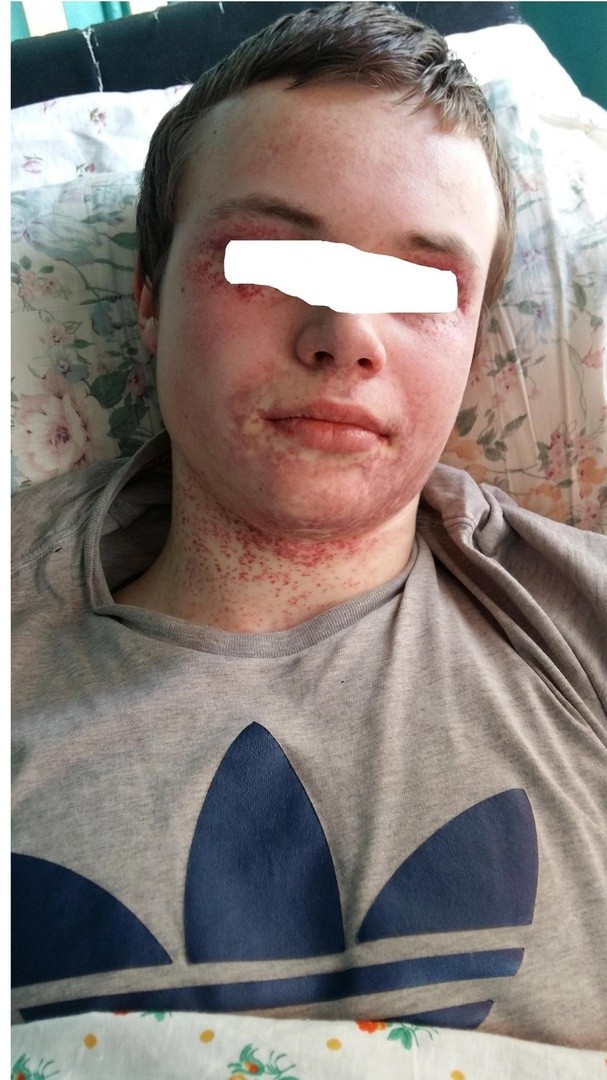 Антибиотик Аугментин напугал соцсети