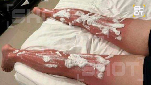 Мальдивы превращаются в «гриль»: туристы из России массово обгорают.