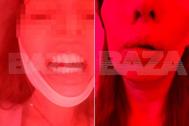 Жительницу Екатеринбурга изуродовали в частной стоматологии за 2 млн рублей - она не может нормально есть и говорить