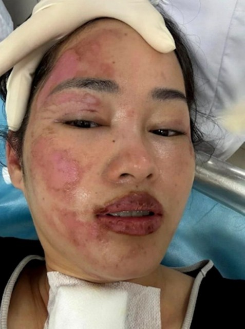 Блогерша из Вьетнама получила ожоги лица из-за взрыва шаров с водородом