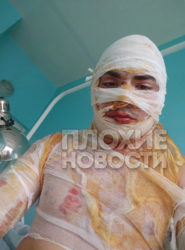 В Тольятти молодому парню сожгли лицо во время фаер-шоу в баре: жуткие кадры попали на видео