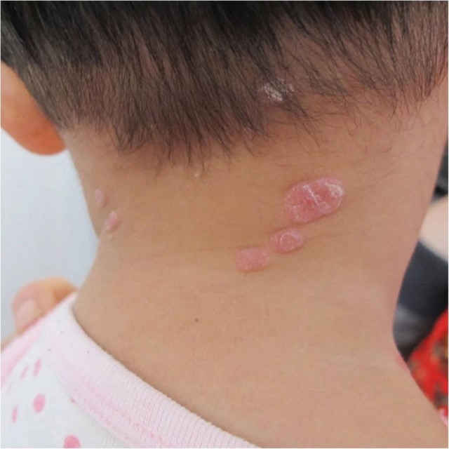 Сифилис у 3х летнего ребенка из-за бабушки