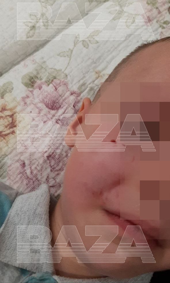 В Краснодаре резвая собака на секунду вырвалась из рук хозяина и укусила за лицо мальчика, который ехал с ней в лифте.