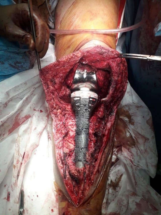 Протезирование коленного сустава