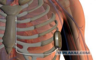 Теперь ты Киборг. Фирмы Boston Scientific