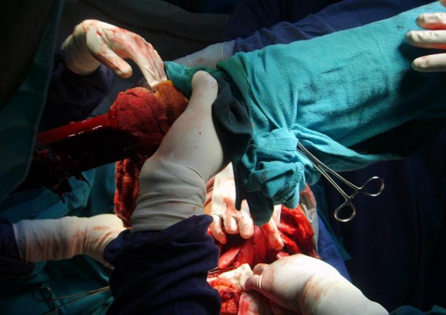 Португальский парень чудом выжил, после того как его проткнуло железякой