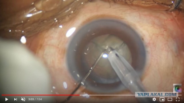 Что ищут офтальмологи у пациентов с катарактой?