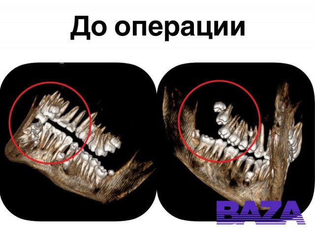 В Московской области у подростка нашли 14 лишних зубов