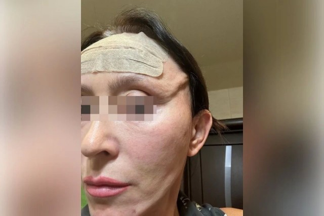 В Новосибирске женщина отдала 1,3 миллиона за пластику и осталась с дырой вместо подбородка