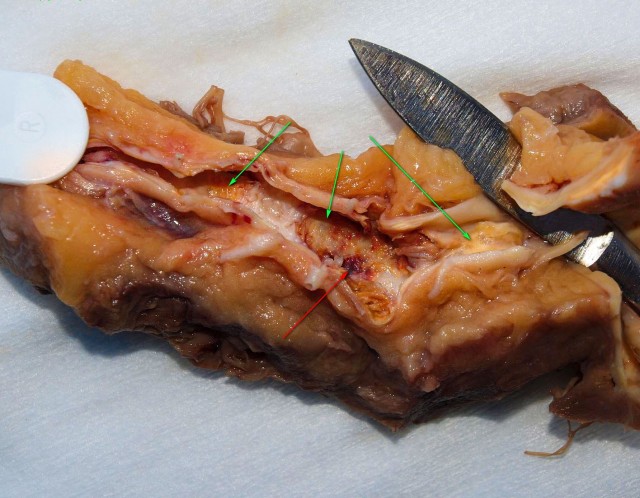 "Борьба" с атеросклерозом подручными средствами